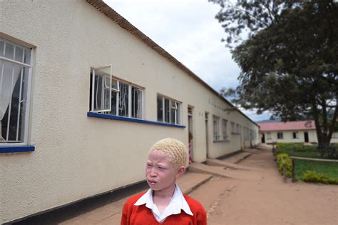 Living With Albinism In Uganda Dana Ullman