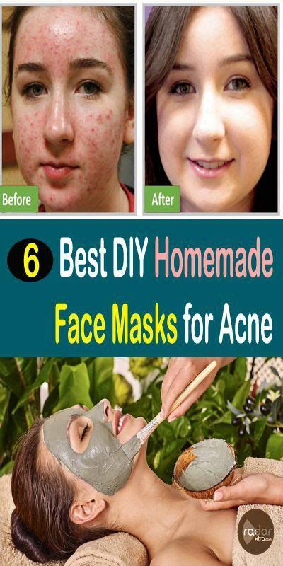 6 Best Diy Homemade Face Masks For Acne Easyfacemaskdiy Acne Face