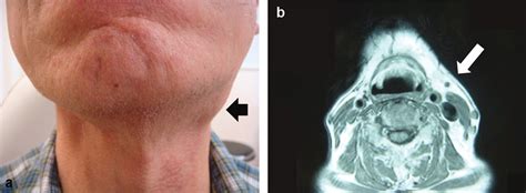 A New Category For Chronic Sclerosing Sialadenitis As An Igg4 Related