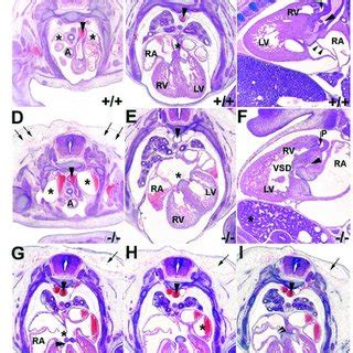 Histological Examination Of Cardiac Abnormalities In Tll1 13 5 Dpc