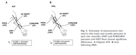 Hemodynamic Effect Of Distal Revascularization Interval Ligation Drill