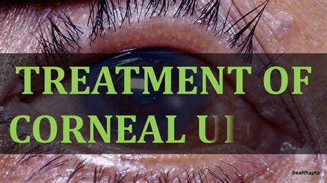 Treatment Of Corneal Ulcer Youtube