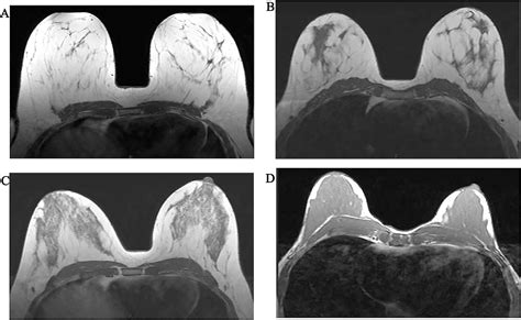 Background Parenchymal Enhancement And Fibroglandular Tissue On Breast