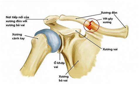 gay xuong don thuong tat bao nhieu phan tram