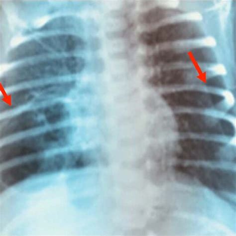 CONTROL CHEST X-RAY. In right cavitary image. Minimal pneumothorax on ...