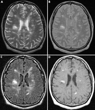 Imaging in multiple sclerosis | Journal of Neurology, Neurosurgery ...