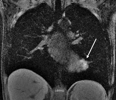 Atypical Sites Of Deeply Infiltrative Endometriosis Clinical Characteristics And Imaging