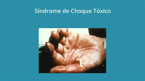 Síndrome De Choque Toxico Youtube