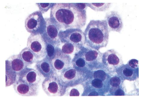 Fine Needle Aspiration Biopsy Diagnosis Of Renal Cell Carcinoma A