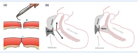 Figure From Why Do Niches Develop In Caesarean Uterine Scars