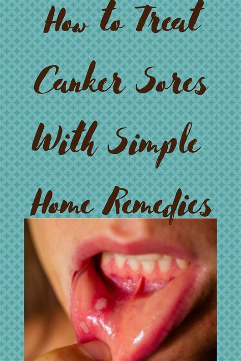 The Most Effective Home Remedy Treatments For Your Canker Sores Artofit