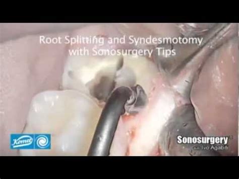 Komet Inserts Sonosurgery YouTube