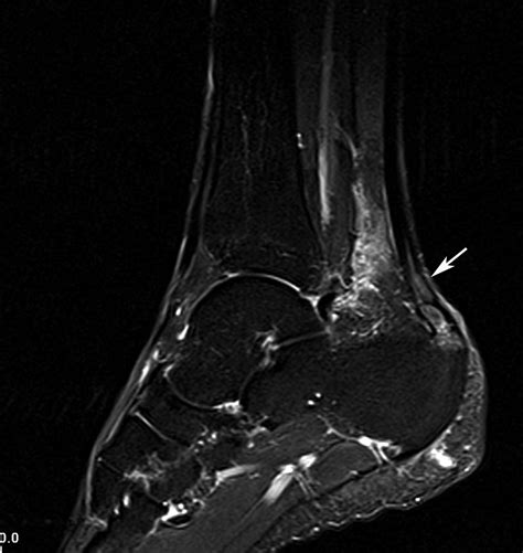 Radiodiagnosis - Imaging is Amazing-Interesting cases: Achilles Tendonitis - MRI