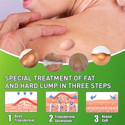 Sumifun Lipoma Removal Cream Relief Pain Treat Skin Swelling Lipolysis