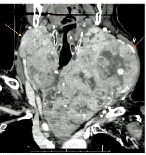 Multinodular Goiter Ultrasound