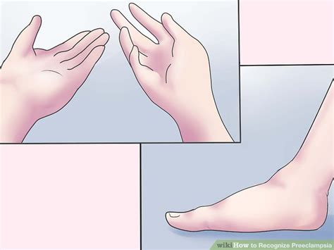 How To Recognize Preeclampsia 14 Steps With Pictures Wikihow