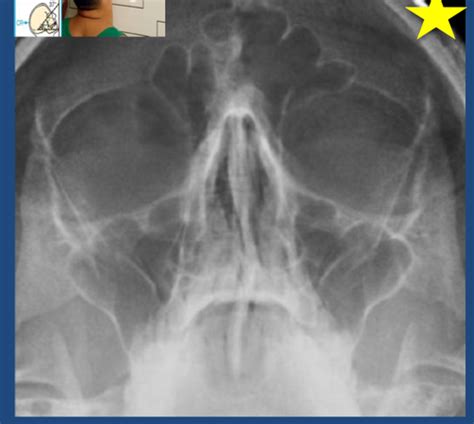 Radiographs Flashcards Quizlet