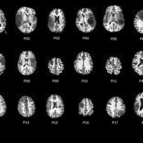 weighted axial mri slices displaying patient brain tumor anatomy