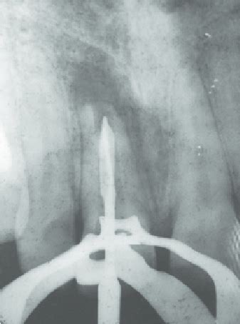 Working Length Determination Radiograph After Complete Removal Of