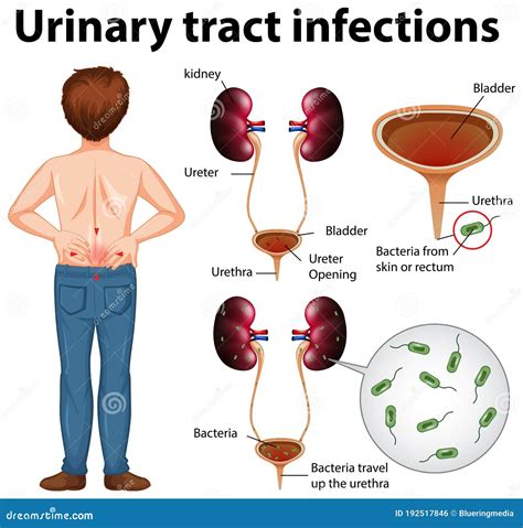 Ilustración Informativa De Infecciones Del Tracto Urinario Ilustración Del Vector Ilustración