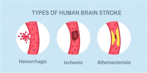 Premium Vector Types Of Human Brain Stroke Ischemic Atherosclerosis