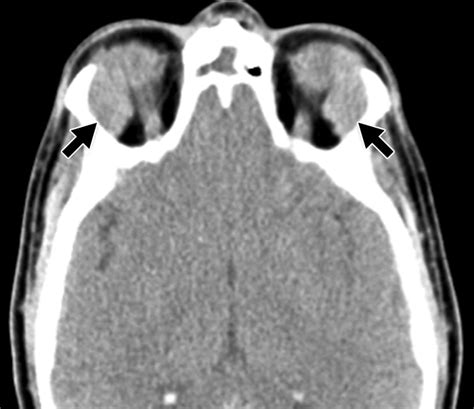 Lacrimal Gland Masses Ajr