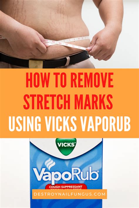 How To Use Vicks Vaporub For Stretch Marks That Wont Fade Away