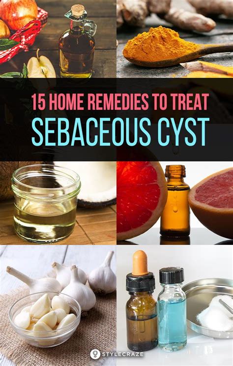 Effective Home Remedies To Treat Sebaceous Cyst: These cysts are ...