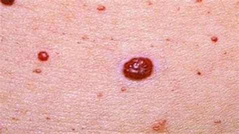 Red moles on skin: Causes and treatment options