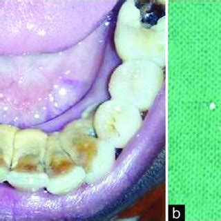 A Intraoral Photograph Showing Dental Calculus On Lingual Surface Of