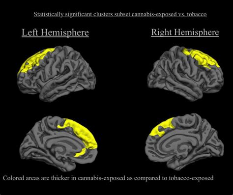 Prenatal Cannabis And Tobacco Exposure In Relation To Brain Morphology