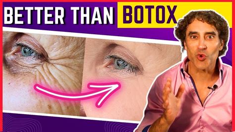 Botox Crows Feet Treatment Artofit