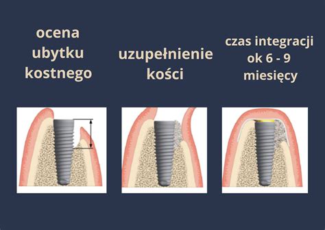 Sterowana Regeneracja Kości GBR Boutique Dental