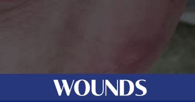 Infectious Wounds Archives - Wound Care Weekly