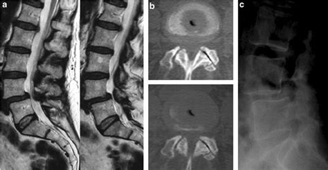 Imaging Of The Spinal Instability Sagittal T2 Weighted Images