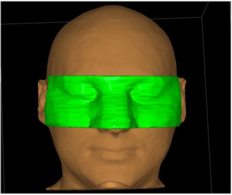 Jpm Free Full Text Personalized Superficial Hdr Brachytherapy