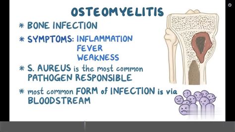 Osteomyelitis Causes Symptoms Diagnosis And Treatment Pathology Youtube