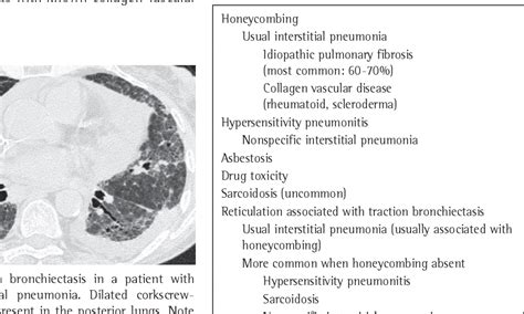 Figure 1 From High Resolution Computed Tomography Patterns Of Diffuse Interstitial Lung Disease