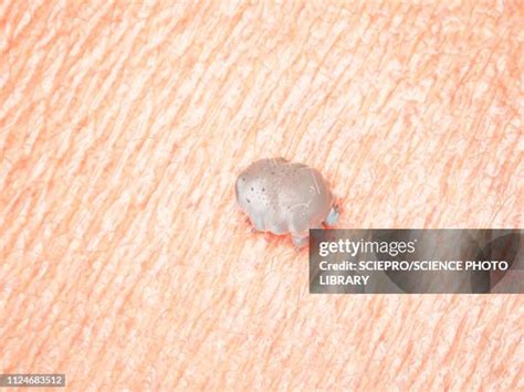 Scabies Mites Photos and Premium High Res Pictures - Getty Images