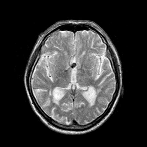 Anterior Communicating Artery Aneurysm Image