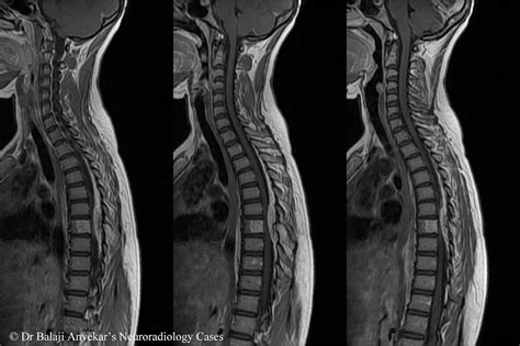 Dr Balaji Anvekar FRCR: Spinal epidural lesion causing cord compression MRI