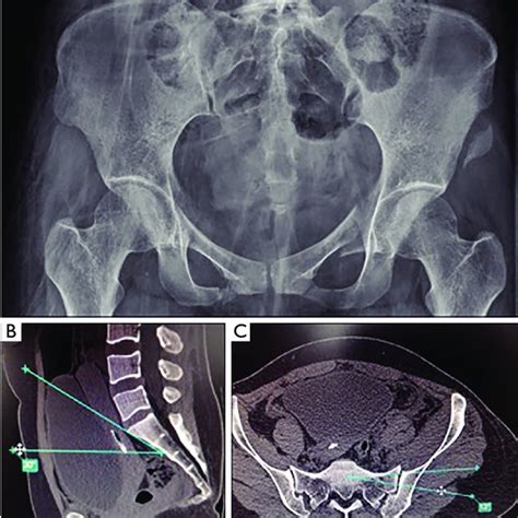 Pdf Treating Sacroiliac Joint Dislocation Through Percutaneous