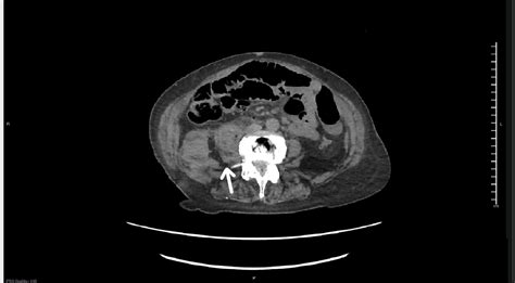 Iliopsoas Rupture And Hematoma A Rare Cause Of Inability To Ambulate EMRA