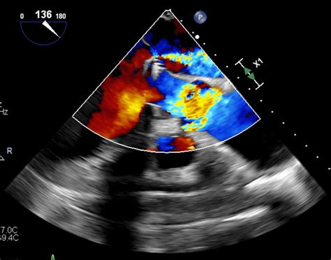 PostMitraClip Midesophageal Longaxis View With Color Doppler Showing