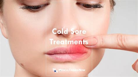 How to Treat Cold Sores: What You Should Know and What to Do - Medical Trends Now