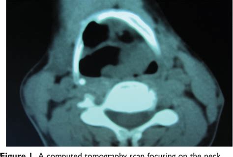 Figure 1 From A Rare Finding Of Multiple Schwannomas In The Epiglottis