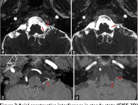 Figure From Glossopharyngeal Neuralgia Caused By A Complex