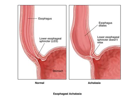 Achalasia GBMC Jordan