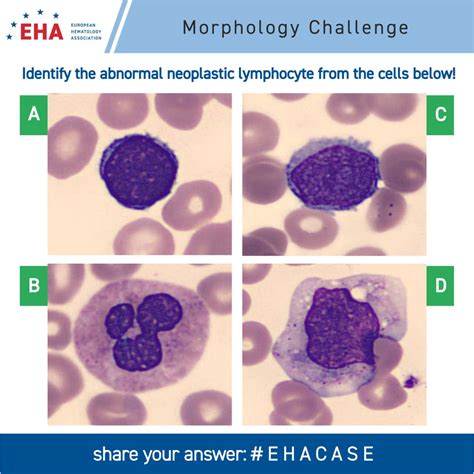 European Hematology Association On Twitter Welcome To Ehacase Today