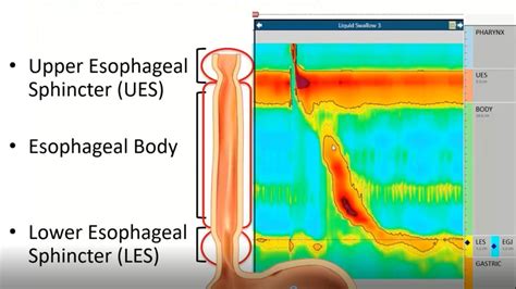 High Resolution Esophageal Manometry Start To Finish Webinar Series